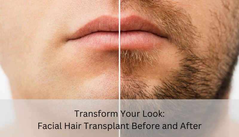 Facial hair transplant before and after